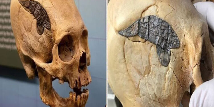 Archaeologists Stunned As 2,000-Year-Old Skull Bound By Metal Evidence Of Ancient Surgery